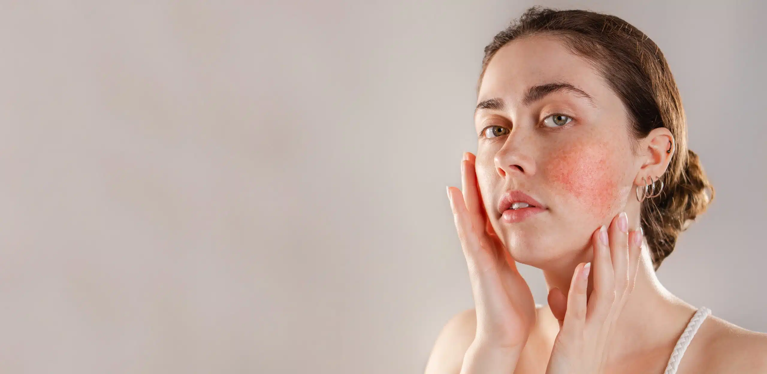 Rosacea Treatment in Winter Park Rosacea Treatment in Winter Park