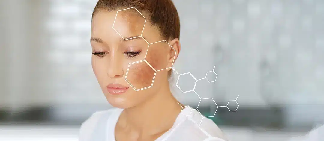 Expert Skin Discoloration Treatment in Winter Park, FL