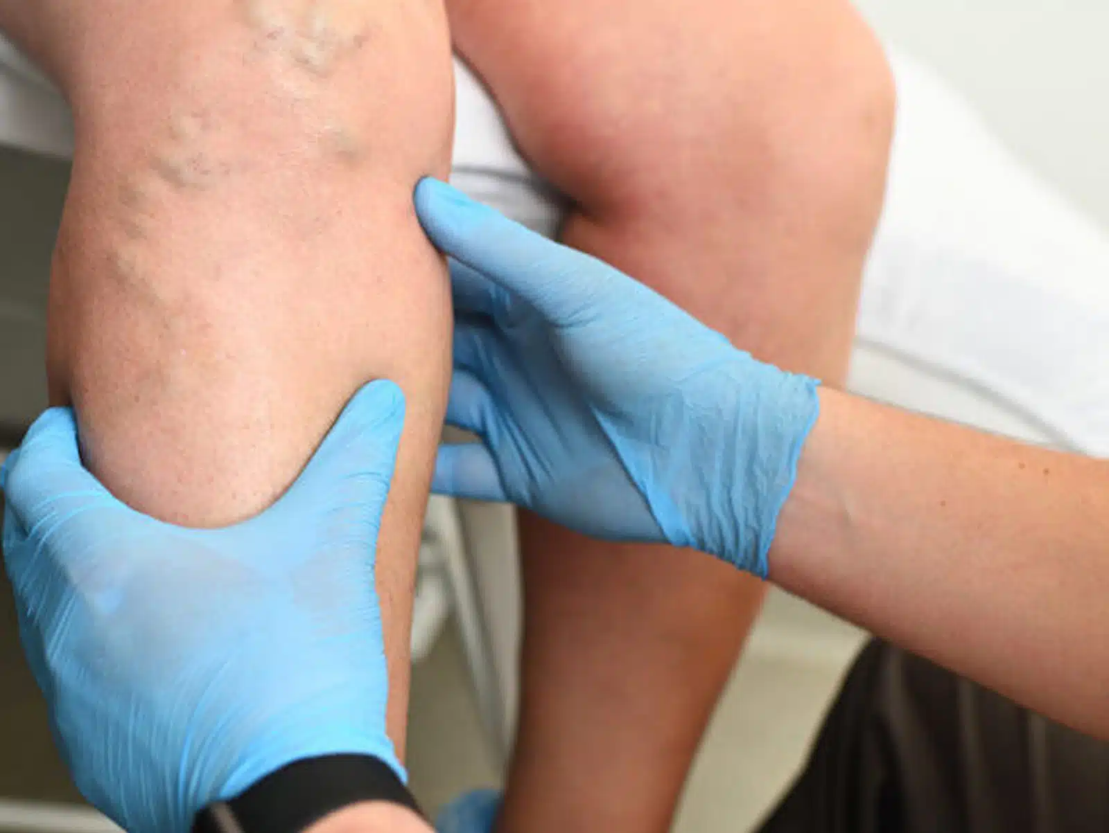 Varicose Vein Treatment Options