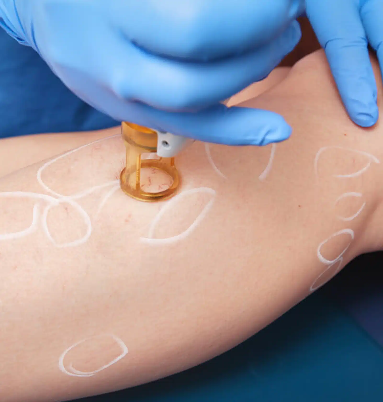 Varicose Veins Treatment Winter Parkk FL